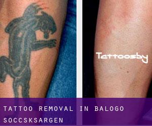 Tattoo Removal in Balogo (Soccsksargen)