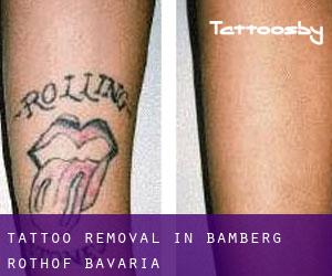 Tattoo Removal in Bamberg, Rothof (Bavaria)