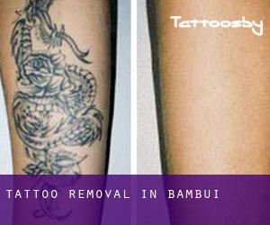 Tattoo Removal in Bambuí