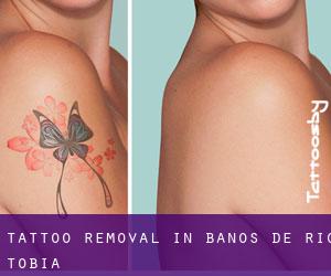 Tattoo Removal in Baños de Río Tobía
