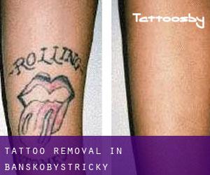 Tattoo Removal in Banskobystrický