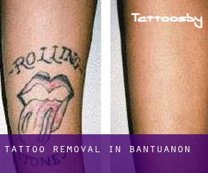 Tattoo Removal in Bantuanon