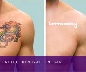 Tattoo Removal in bar