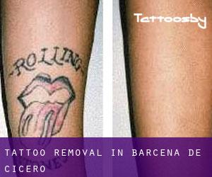Tattoo Removal in Bárcena de Cicero