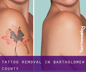 Tattoo Removal in Bartholomew County
