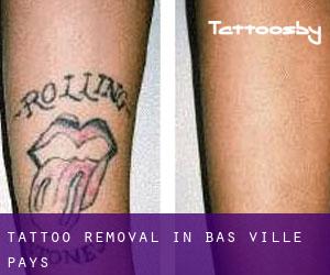Tattoo Removal in Bas Ville-Pays