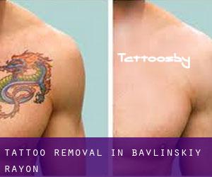 Tattoo Removal in Bavlinskiy Rayon