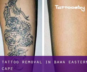 Tattoo Removal in Bawa (Eastern Cape)