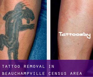 Tattoo Removal in Beauchampville (census area)