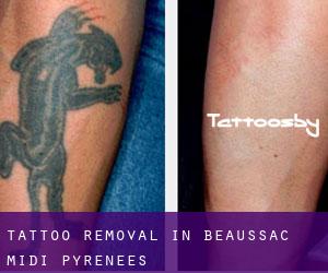 Tattoo Removal in Beaussac (Midi-Pyrénées)
