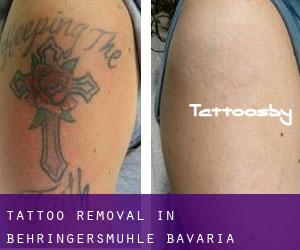Tattoo Removal in Behringersmühle (Bavaria)
