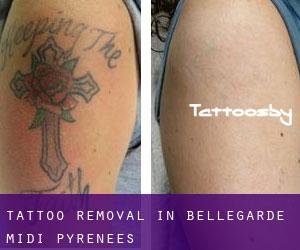 Tattoo Removal in Bellegarde (Midi-Pyrénées)