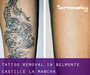 Tattoo Removal in Belmonte (Castille-La Mancha)