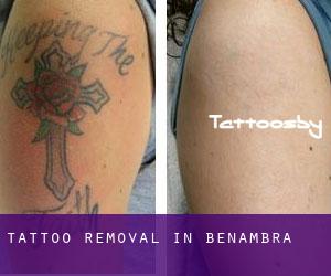Tattoo Removal in Benambra