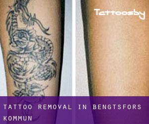 Tattoo Removal in Bengtsfors Kommun