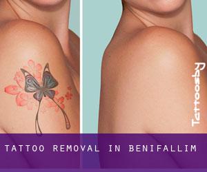 Tattoo Removal in Benifallim