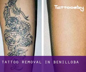 Tattoo Removal in Benilloba