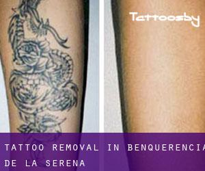 Tattoo Removal in Benquerencia de la Serena