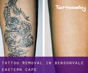 Tattoo Removal in Bensonvale (Eastern Cape)