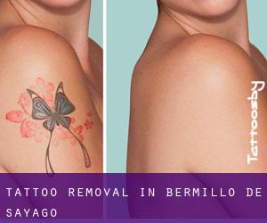 Tattoo Removal in Bermillo de Sayago