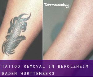 Tattoo Removal in Berolzheim (Baden-Württemberg)