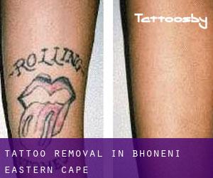 Tattoo Removal in Bhoneni (Eastern Cape)