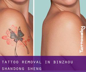Tattoo Removal in Binzhou (Shandong Sheng)