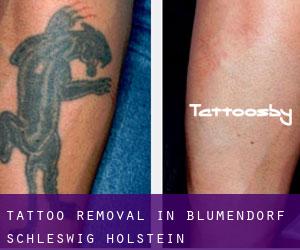 Tattoo Removal in Blumendorf (Schleswig-Holstein)