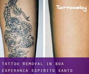 Tattoo Removal in Boa Esperança (Espírito Santo)