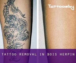 Tattoo Removal in Bois-Herpin