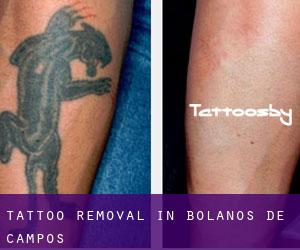 Tattoo Removal in Bolaños de Campos