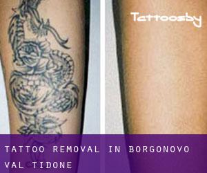 Tattoo Removal in Borgonovo Val Tidone