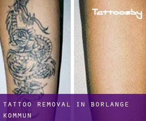 Tattoo Removal in Borlänge Kommun