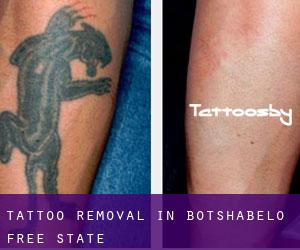 Tattoo Removal in Botshabelo (Free State)