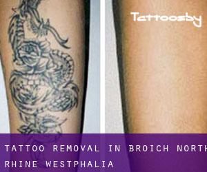 Tattoo Removal in Broich (North Rhine-Westphalia)