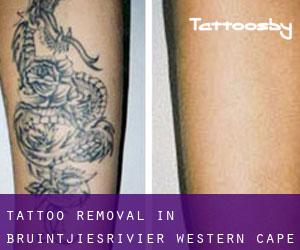 Tattoo Removal in Bruintjiesrivier (Western Cape)
