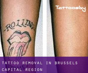 Tattoo Removal in Brussels Capital Region