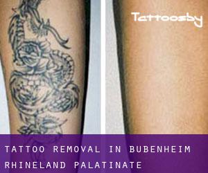 Tattoo Removal in Bubenheim (Rhineland-Palatinate)