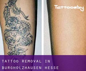 Tattoo Removal in Burgholzhausen (Hesse)
