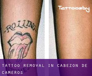 Tattoo Removal in Cabezón de Cameros