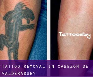 Tattoo Removal in Cabezón de Valderaduey