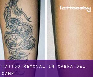 Tattoo Removal in Cabra del Camp
