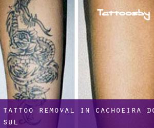 Tattoo Removal in Cachoeira do Sul