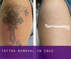 Tattoo Removal in Caçu