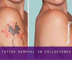 Tattoo Removal in Calldetenes