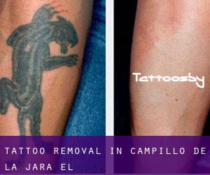 Tattoo Removal in Campillo de la Jara (El)