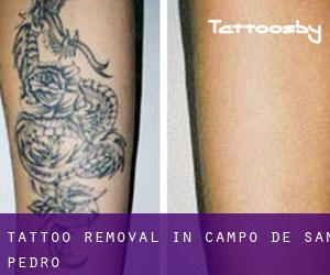 Tattoo Removal in Campo de San Pedro