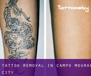 Tattoo Removal in Campo Mourão (City)