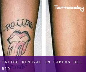 Tattoo Removal in Campos del Río
