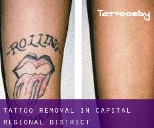 Tattoo Removal in Capital Regional District